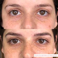 Freckle tattoos work just like any other tattoo, whereby pigment is deposited below the skin. Freckles Micro Penny