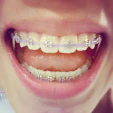 Clear Braces Color Lilac Recherche Google Aparelho Dentario Aparelho