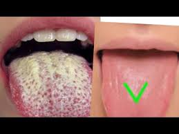 Check spelling or type a new query. Best Natural Way To To Get Rid Of White Tongue Remove Bad Breath Clean Dirty Tongue Youtube