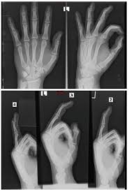 Image result for Hand Fracture