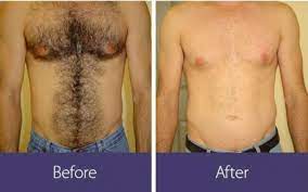 Home » faqs » hair removal » how long does laser hair removal last? How Long Does Laser Hair Removal Last Boston Laser Hair Removal Krauss Dermatology