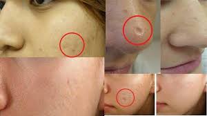 Secara realistis, bekas jerawat memang tidak dapat dihilangkan dalam sekejap, tetapi dengan pengobatan, produk, perawatan, dan kiat perawatan kulit, anda bisa melihat perbedaan yang signifikan seiring berjalannya waktu. Jangan Dulu Over Thingking Begini Cara Mudah Menghilangkan Bopeng Bekas Jerawat Halaman All Tribun Batam