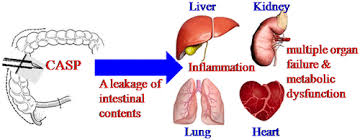 In casp, a stent is inserted into the ascending colon, which generates a septic focus. Colon Ascendens Stent Peritonitis Casp Induces Excessive Inflammation And Systemic Metabolic Dysfunction In A Septic Rat Model Journal Of Proteome Research X Mol