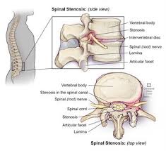 How many platelets are there in one cubic millimeter? Spinal Stenosis What Is It Symptoms Causes Treatment Surgery