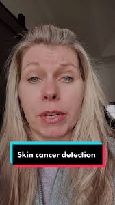 Skin Cancer Awareness PSA: Pimple Turn into Cancer