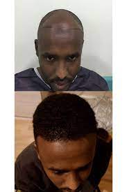 View 5,132 before and after hair transplant photos, submitted by real doctors, to get an idea of the results patients have seen. Afro Hair Transplants All You Need To Know Qunomedical