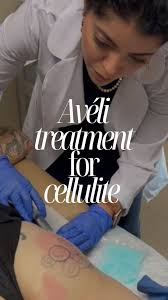 Take a peak as Dr. Gabro’s performs an Avéli treatment for cellulite!, Say  goodbye to cellulite with Avéli! 🌟✨, Discover the revolutionary Avéli  Cellulite Treatment, designed to smooth and rejuvenate ...