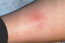 Here are 14 signs of spider bites. A Spider Bite That Wasn T Clinician Reviews