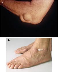 Image result for Panniculitis