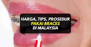 Harga bagi rawatan braces di klinik kerajaan dan swasta tentunya berbeza. Harga Braces Prosedur Tips Pendakap Gigi Di Malaysia
