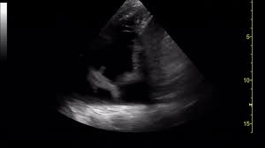 Check spelling or type a new query. Baby Shark Pleural Effusion On Pocus Tanya Specht Grepmed