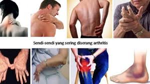 Apa kata dr azrul tentang sakit lutut dan supplement berkesan untuk sakit lutut. Penderita Radang Sendi Hindari Makanan Ini Health Liputan6 Com