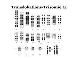 Trisomie 21