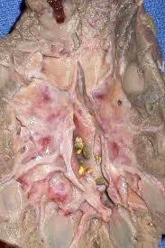 A stone in the kidney (or lower down in the urinary tract). Kidney Stone Frequently Asked Questions