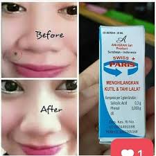 391 likes · 1 talking about this. Cod Penghilang Tahi Lalat Efeketif Menghilangkan Tahi Lalat Shopee Indonesia