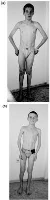 Nord guide to rare disorders. Early Onset Of Cardiomyopathy In Two Brothers With X Linked Emery Dreifuss Muscular Dystrophy Neuromuscular Disorders
