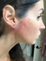 Who treats poison ivy and how?