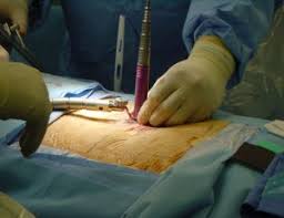 Jazzman riffs on britten's piano. Minimally Invasive Spine Surgery Neurosurgery