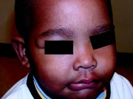 Lumps and bumps in neonates and infants