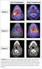 management of tonsillar carcinoma with advanced radiation