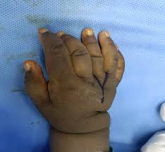 Image result for Supernumerary Digit