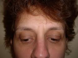 Consultati oferta noastra de pret pentru fiecare interventie in parte. Medlife Blefaroplastie Pret Despre ViaÈ›a Din Romania