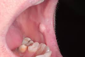 Introduction fibroma is a benign neoplasm of fibroblastic origin and it is rare in the oral cavity (scully, 2010). Pathology Outlines Irritation Fibroma