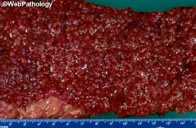 Image result for Ulcerative Colitis