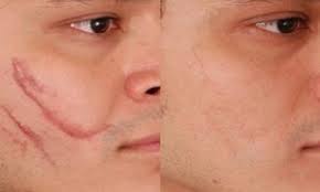 Segala parut chicken pox yang menjengkelkan itu telah lenyap sama sekali. Petua Menghilangkan Parut Chicken Pox Cara Tradisional