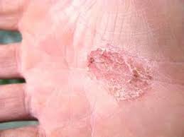 There are many ways to treat psoriasis, and your treatment plan will depend on the type of disease and how. Curado Da Psoriase Estou Curado Da Psoriase Psoriase Psoriase Tratamento Tratamento Psoriase