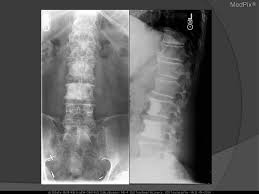 The pancreas is a bodily organ that few people think about. Medpix Case Metastatic Prostate Cancer Blastic