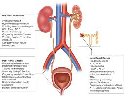 Image result for Postrenal Failure