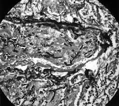 Es una infección aguda, a menudo mortal, que se produce por hongos del orden mucorales. Mucormicosis Pulmonar