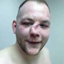 Symptoms typically include pain and swelling around the nose, bleeding, nasal discharge, and difficulty breathing. I Think My Nose Is Broken Imgur