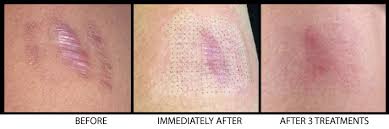 We did not find results for: Co2 Laser Resurfacing Tareen Dermatology Roseville Minnesota