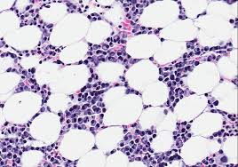 Image result for Multiple Myeloma