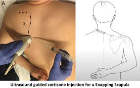 Image result for Scapulothoracic Injection