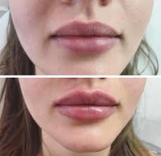 Lip Fillers Guide Type Of Lip Injections Costs And Side