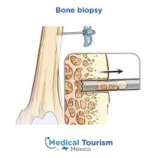 A biopsy is a medical test commonly performed by a surgeon, interventional radiologist, or an interventional cardiologist. Top Specialists For Bone Biopsy Medical Tourism Mexico
