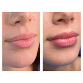 Lip Filler