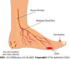 Image result for IDSA Diabetic Foot Wound Classification