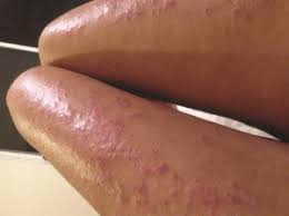 We did not find results for: Hope For Eczema Drug Ranges From Asthma To Food Allergies