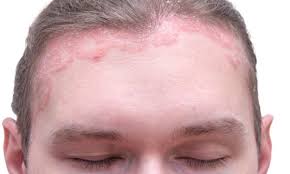 While i'm not sure about whether or not your medication is the cause, we do have an article with information about hair loss with psoriasis that i wanted to share with you. Is Novartis Psoriasis Drug Going To Steal Humira S Crown