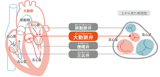 1 definitions matched, 0 related definitions, and 0 example sentences definition of 肺動脈弁狭窄症. å¤§å‹•è„ˆå¼ç‹­çª„ç—‡ã¨ã¯ Taviã®æƒ…å ±ã‚µã‚¤ãƒˆ