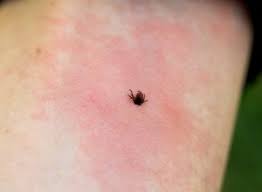 Le livedo qui peut également concerner des érythèmes actifs. Maladie De Lyme Epidemiologie Symptomes Traitement