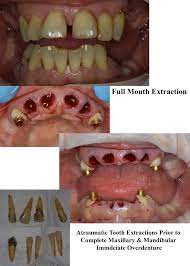 Tooth extraction is the most common oral surgery. Oral Surgery Wisdom Tooth Extraction