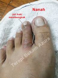 Klinik pakar kulit annur is a skin specialist based in bangi, selangor. Eczema Dan Sakit Kulit Bekam Wanita