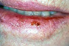 What some oral (mouth) cancers look like these photographs are not meant to scare you. Oral Cancer Wikipedia