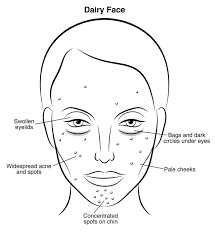 The Scary Truth What Wine Sugar Gluten Dairy Are Doing To Your Skin Face Mapping Acne Acne Spots Acne Cure
