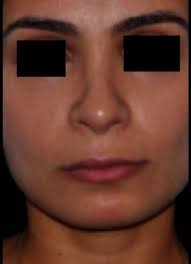 What Can I Do About The Long Philtrum While it serves no purpose in life, scientists have known as the philtrum, it's the place where the various sections of our faces join like pieces of a. what can i do about the long philtrum